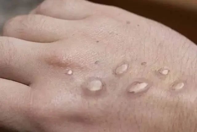 پاکستان میں منکی پاکس کا پہلا مشتبہ کیس سامنے آگیا