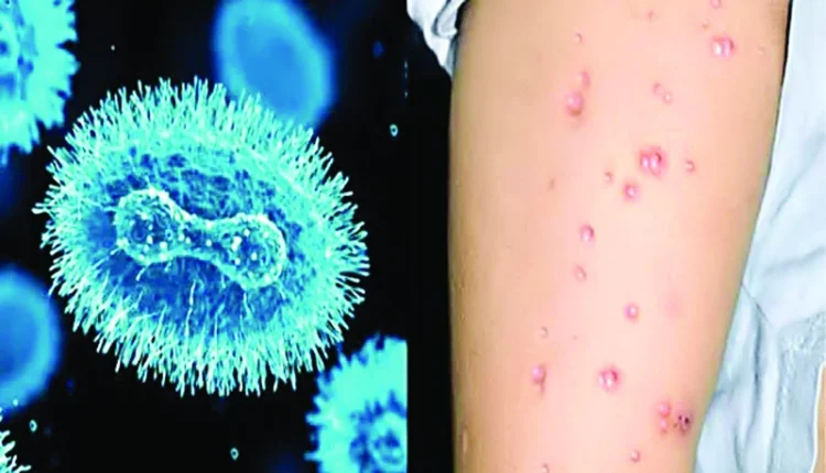 منکی پوکس کی علامات کیا ہیں؟